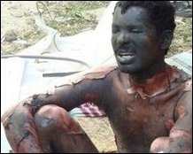Tamil victim of Sri Lanka's war, signs of chemical warfare