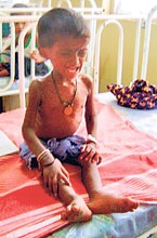 malnourished-child