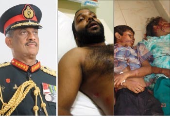 Sarath Fonseka, Namal Perera after being attacked AND Tamil civilians killed during the war Picture courtesy: www.asiantribune.